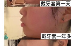 中外正畸有何不同？技术理念效果差异大吗？