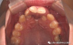 口腔正畸 唇腭裂