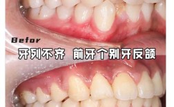 矫正牙齿前排不齐