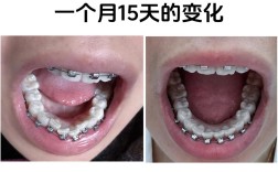 39岁矫正牙齿可行吗？成年人矫牙还来得及吗？