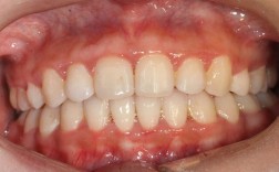 牙齿矫正后牙龈萎缩图，为何会出现牙龈萎缩？