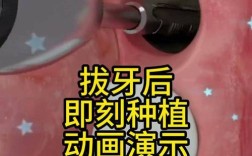 拔牙后到底能不能马上种牙？即刻种植真的可行吗？需要满足哪些条件？风险和效果又如何？