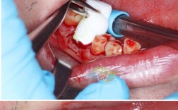 下颌智齿创口缝合方法