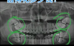 正畸拔4颗尖牙，真的有必要吗？