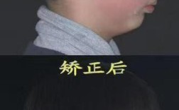 颌骨发育不足正畸，诊断方法如何影响矫治效果？