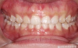 牙齿矫正后为何还有缝隙？会慢慢消失吗？