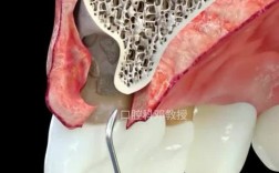 牙周植骨适应证