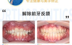 乳前牙反合的治疗方法有哪些？不同病例如何针对性选择？