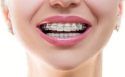 隐形牙齿矫正效果究竟如何？真实效果大揭秘？