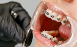 美国人矫正牙齿