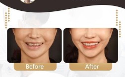 爱优牙牙齿矫正效果怎么样？适合哪些人做呢？