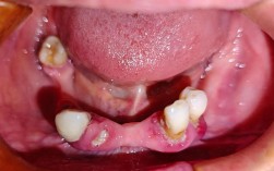 半口种牙后到底能不能吸烟？这样做会对种植体存活和口腔恢复期造成哪些不可逆的影响？