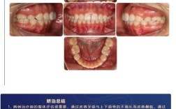 安氏二类错颌矫正方法