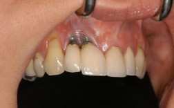 种植牙需要植体露出吗