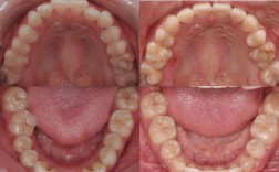 牙齿矫正拔双尖牙，真的有必要吗？会有啥影响？