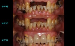 矫正牙齿为何会导致牙神经坏死？