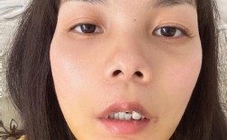 植完牙脸一直肿