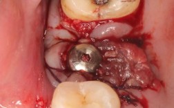 种牙植骨后牙龈肿是什么原因引起的？