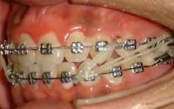 正畸一类牵引方法如何规范操作？适用哪些错颌情况？