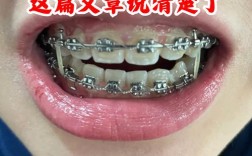 门牙缝正畸关闭间隙有哪些有效方法？