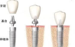 要种20颗种植牙