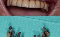 种牙失败还能种吗