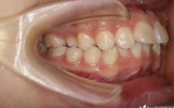 矫正拔牙的牙齿