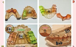 矫正器包含在正畸里吗