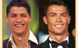 明星拔牙矫正牙齿