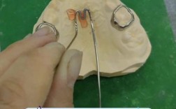 nance弓正畸图片能展示哪些具体矫正细节？