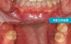 种牙一期后牙槽骨薄