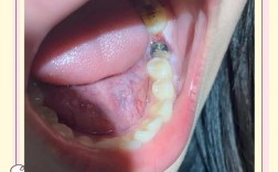 种植牙发臭是怎么回事？如何应对？