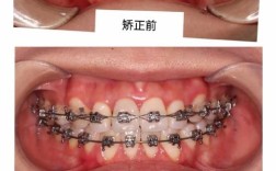 口腔正畸正畸二类骨性