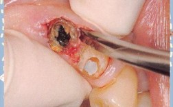 拔残根用什么方法