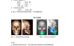 正颌手术术后正畸时间