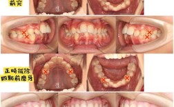 矫正牙齿是不是要拔牙