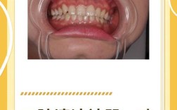 口腔喷砂方法如何操作？步骤与注意事项有哪些？