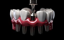 牙齿正畸矫正种植体