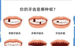 牙齿种植最多能种几颗？数量有上限吗？