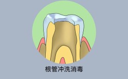 根管消毒的方法有哪些？不同消毒方式的优缺点及适用情况是怎样的？