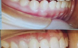 第三次矫正牙齿