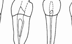 髓腔侧穿后，有哪些补救方法？