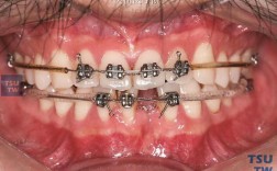 正畸后倾曲弯制6