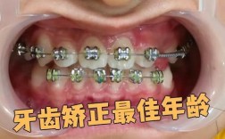 新年牙齿矫正活动有哪些优惠？
