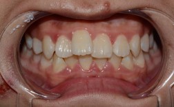 正畸方丝不入槽