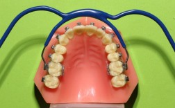 正畸口外弓的适应症