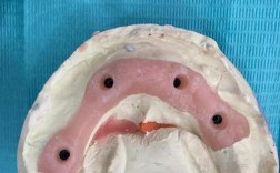 曾经戴过假牙的人，现在还能种牙吗？