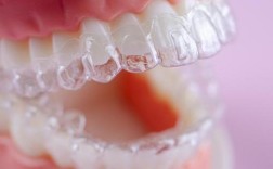 隐形正畸矫治器有哪些类型？哪种更适合自己？