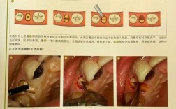 烂牙根只能拔掉种牙吗？还有其他处理方式吗？