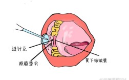 牙槽外科常用麻醉方法有哪些？各有何适应症与操作要点？